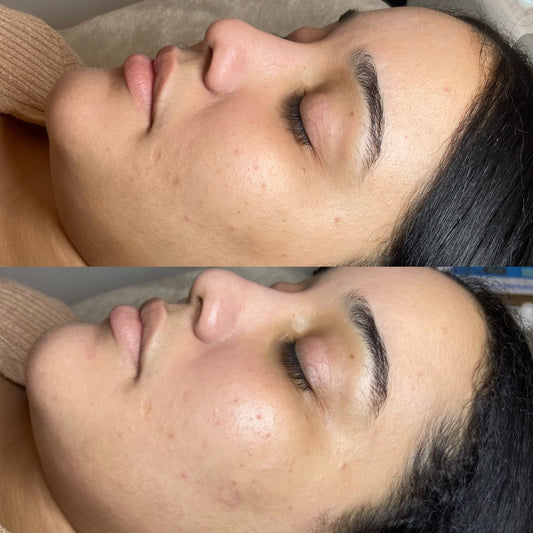 Express Hydro Facial